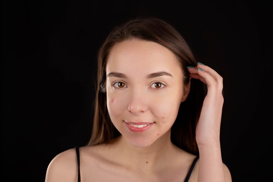How Can I Fade Post-Acne Dark Marks at Home?